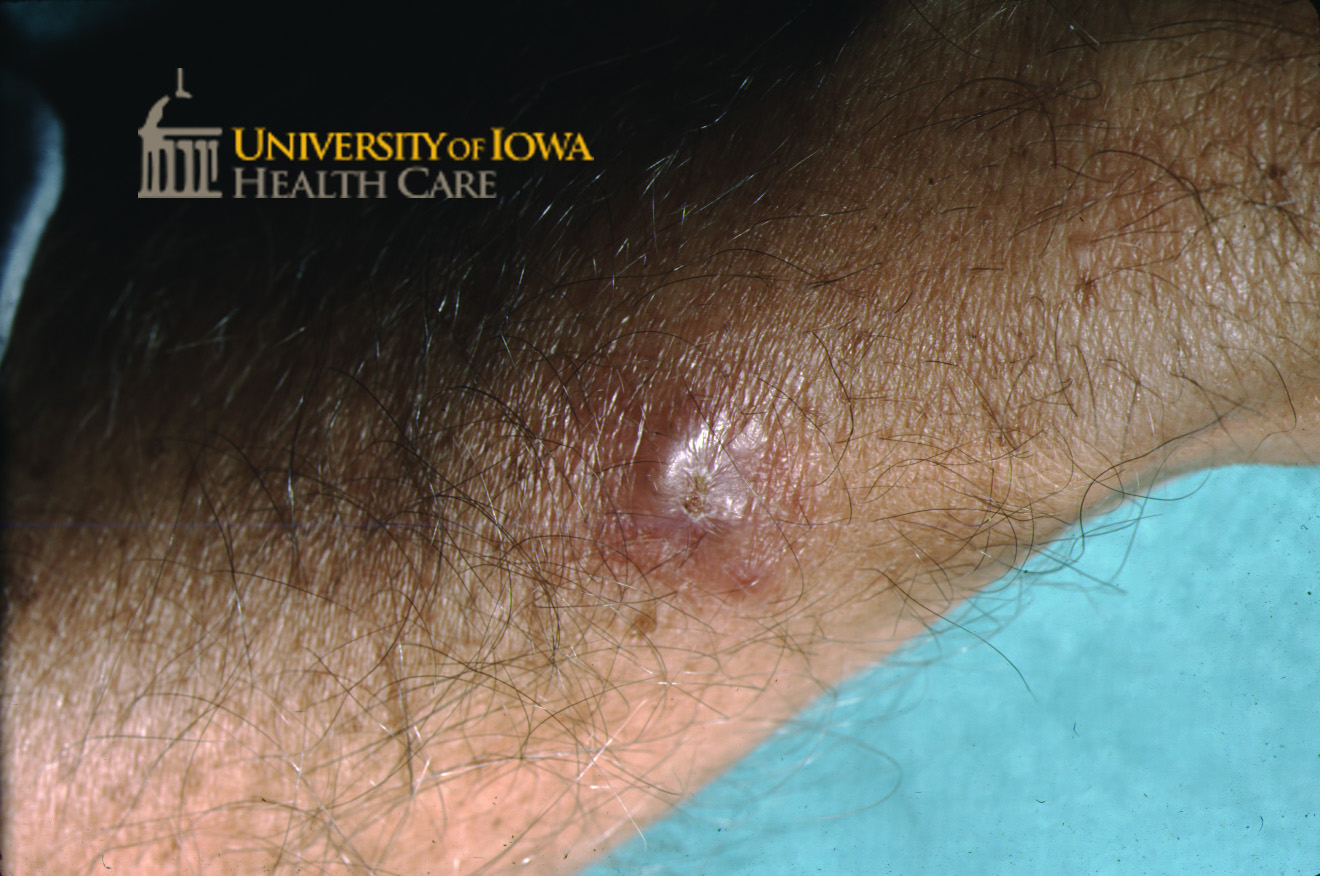 Erythematous nodule with focal area of scale. (click images for higher resolution).